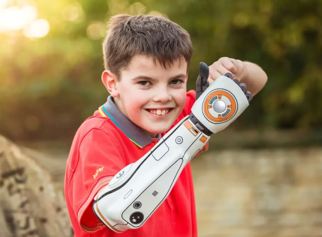 Enfant portant une prothèse bionique Open Bionics inspirée de Star Wars, innovation medtech pédiatrique