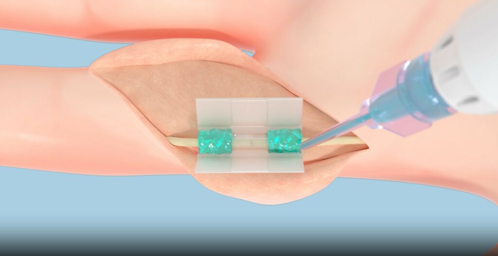 Biomedical polymer used for tissue reconstruction in regenerative medicine